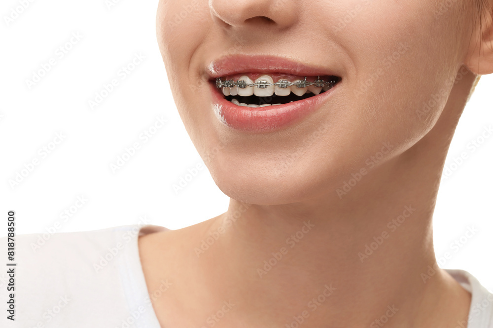 Obraz premium Smiling woman with dental braces on white background, closeup