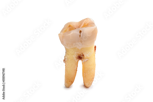 Close-up of tooth with caries isolated on white background. Real human teeth, sick human teeth with clipping path.