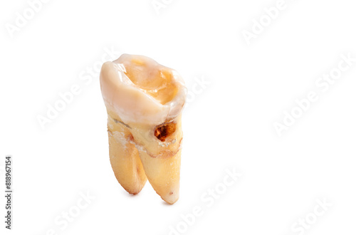 Close-up of extracted tooth with clipping path isolated on a white background.  Macro photograph, real human teeth, tooth with caries