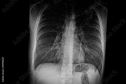 Medical themes: X- ray image of patient  with tuberculosis infection