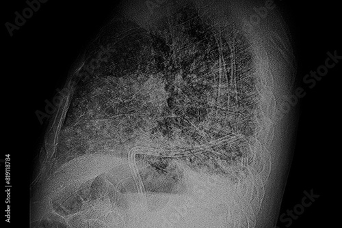 X- Ray image: Multiple small bilateral nodular lesions and  spiculated image on the left lung. Medical themes