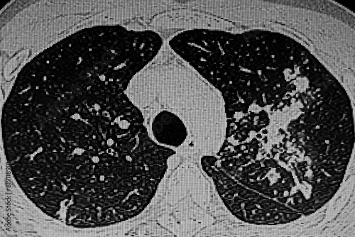 CAT Scan of patient  with tuberculosis infection on left lung.