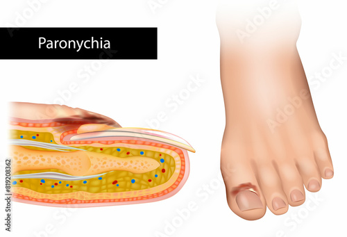 Paronychia is an inflammation of the skin around the nail. Nail Infection photo