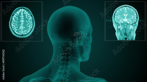 Magnetic resonance scan of the head of a man with visible paranasal Sphenoid sinus. Anatomically correct 3d animation on dark background
