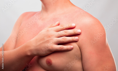 A man with reddened, itchy skin after sunburn on white isolated background. Skin care and protection from the sun's ultraviolet rays.