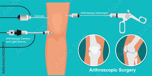 Arthroscopy medical treatment surgery.