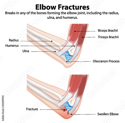 Diagram showing types of elbow fractures photo