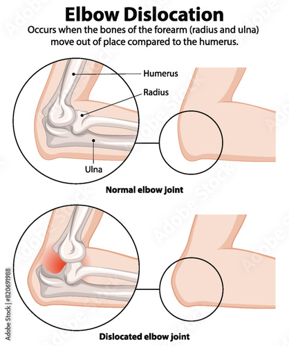 Comparison of normal and dislocated elbow joints