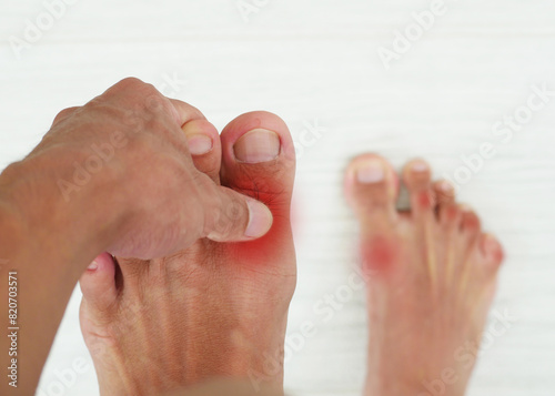 Hand holding sore toe. foot pain, men suffer from foot pain, gout injuries, joint pain. podiatry concept photo