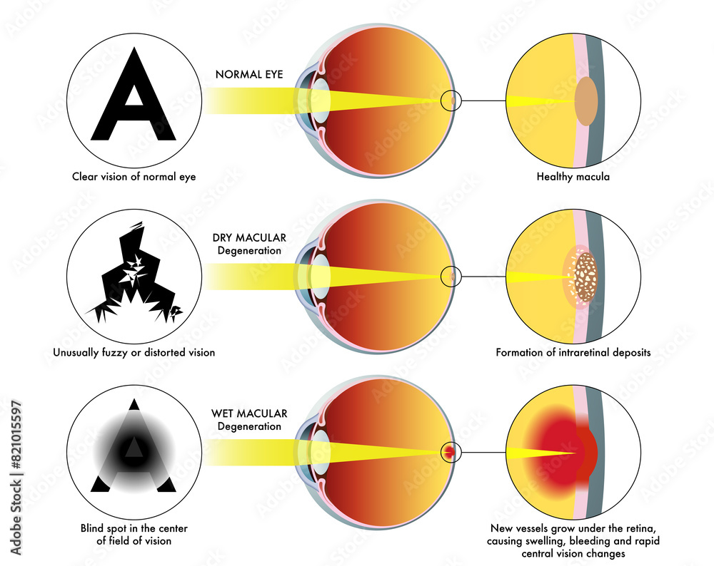 Medical illustration shows a healthy eye and symptoms affecting an eye ...