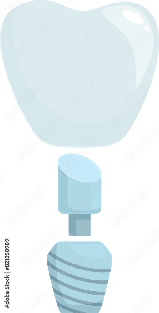 Detailed dental implant illustration showing the placement of a