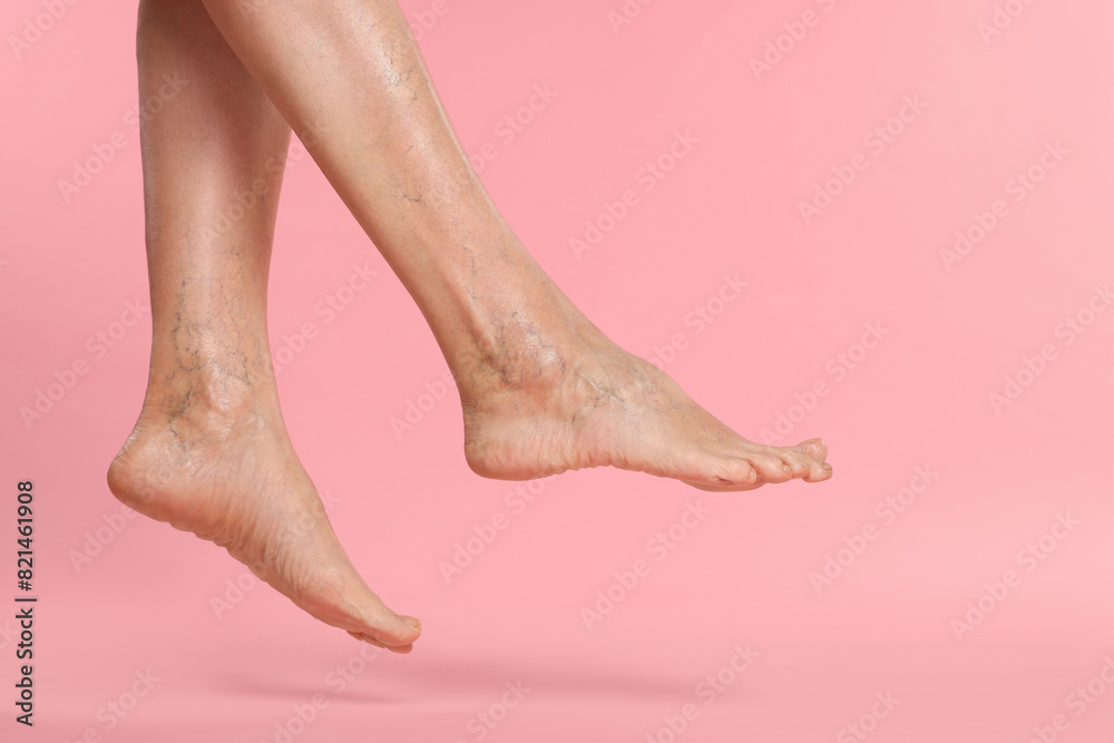 Closeup view of woman with varicose veins on pink background Closeup view of woman with varicose veins on pink background