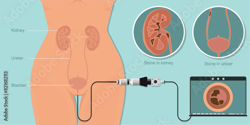 Laparoscope minimally invasive surgery for kidney painful treatment stone removal.