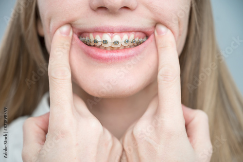 фотографія Close-up of a young woman's smile with metal braces on her teeth