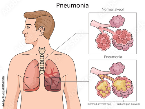 normal alveoli and pneumonia-affected alveoli, highlighting inflamed walls and fluid buildup structure diagram hand drawn schematic vector illustration. Medical science educational illustration
