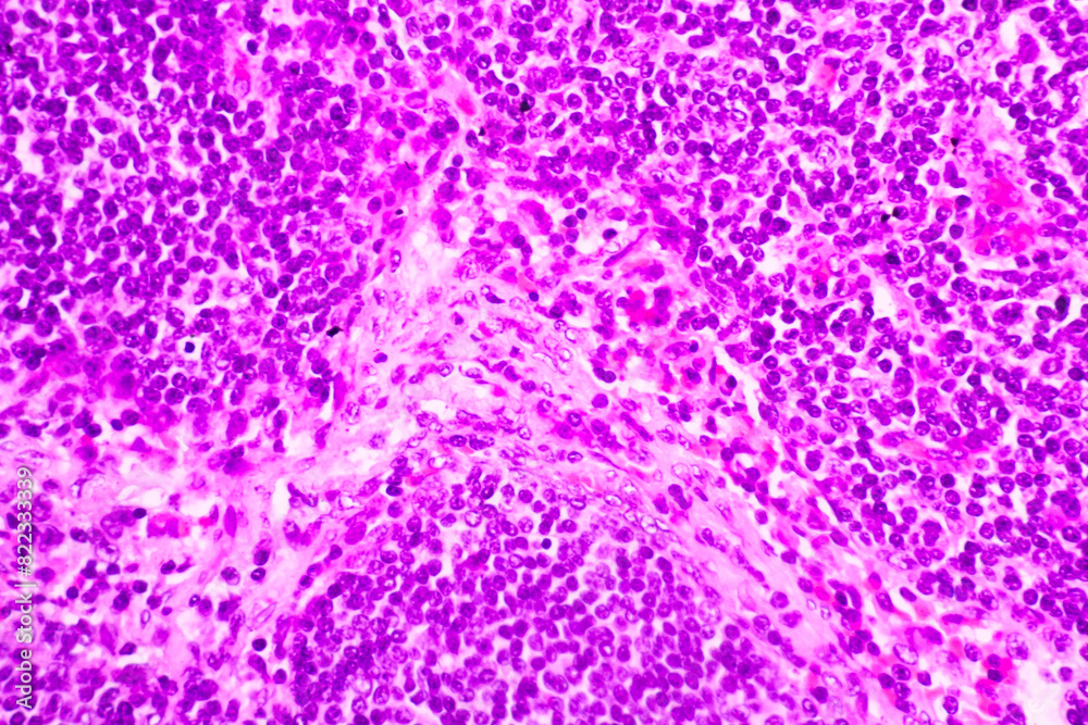 Backgrounds of human cells tissue of cervix under the microscope in pathology lab.View in microscopic of ductal cell carcinoma, adenonocarcinoma from human breast cancer, tissue section by H and E Backgrounds of human cells tissue of cervix under the microscope in pathology lab.View in microscopic of ductal cell carcinoma, adenonocarcinoma from human breast cancer, tissue section by H and E