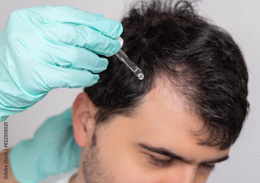man with baldness on head.doctor in surgical gloves holding syringe, derma roller, oil spray or serum.bald on top of head, showed with comb.hair growth stimulation concept,treatment.isolated guy man with baldness on head.doctor in surgical gloves holding syringe, derma roller, oil spray or serum.bald on top of head, showed with comb.hair growth stimulation concept,treatment.isolated guy
