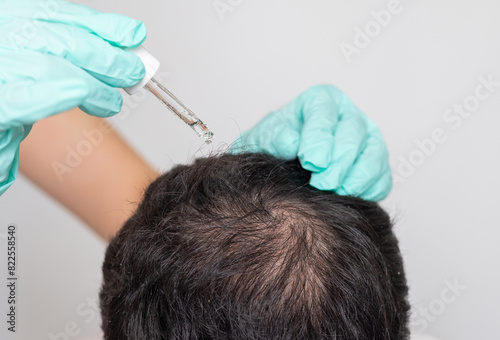 man with baldness on head.doctor in surgical gloves holding syringe, derma roller, oil spray or serum.bald on top of head, showed with comb.hair growth stimulation concept,treatment.isolated guy photo