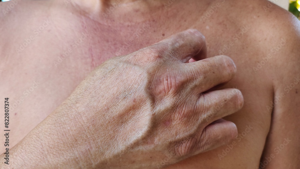 Naklejka premium close up the hand scratching the rash hives allergy and inflammation skin, reaction and urticaria, blackhead and acne on the body, health care and medical concept.