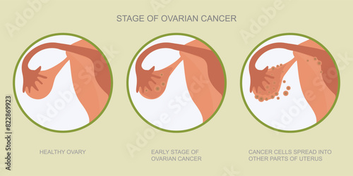 Ovarian cancer refers to any cancerous growth. photo