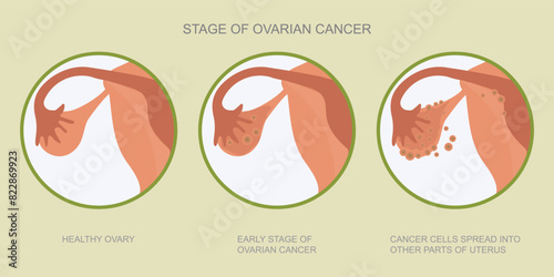 Ovarian cancer refers to any cancerous growth.