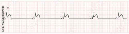 EKG Monitor in lead II Showing  Sinus Bradycardia with STEMI at Inferior Wall
