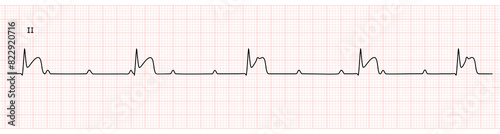 EKG Monitor in lead II Showing  Complete heart block with STEMI at Inferior Wall