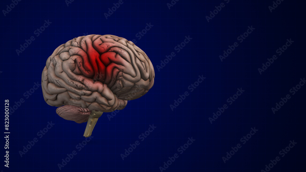 Brain bleed or an intracranial Hemorrhage Brain bleed or an intracranial Hemorrhage
