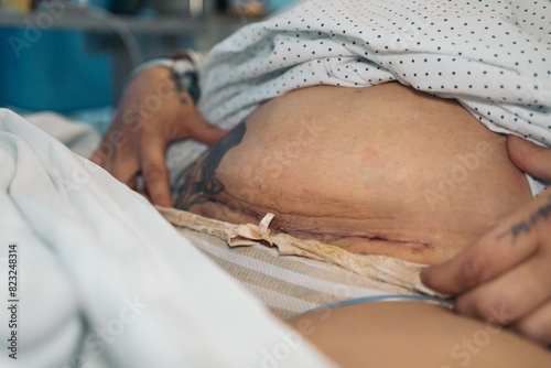 Close-up of a woman's fresh uterine fibroid removal scar with visible previous cesarean marks, unidentifiable.