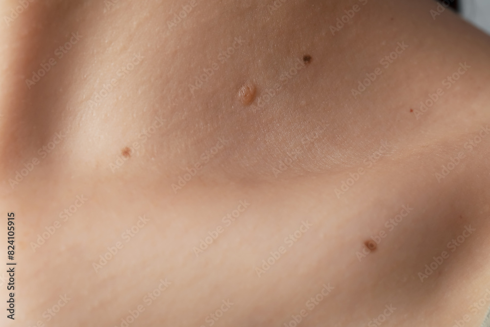 Woman with moles on her body, closeup Woman with moles on her body, closeup