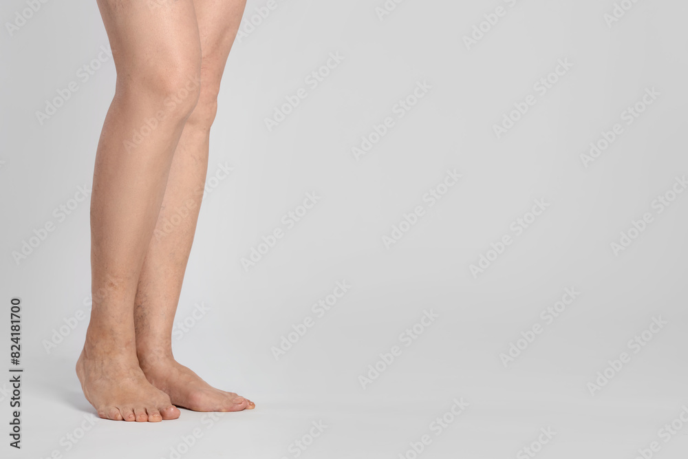 Closeup view of woman with varicose veins on light background. Space for text Closeup view of woman with varicose veins on light background. Space for text