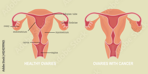 Ovarian cancer refers to any cancerous growth that begins in the ovaries. photo