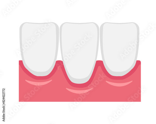 Vector illustration of gingival recession