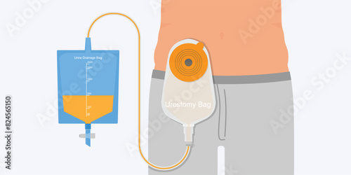 Urostomy bag containing urine flow through small bowel stoma.