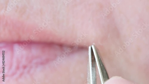 adult woman pulls out, removes with metal tweezers excess hairs on face near the lips, close-up of the problem of female aging skin, wrinkles, home care concept photo