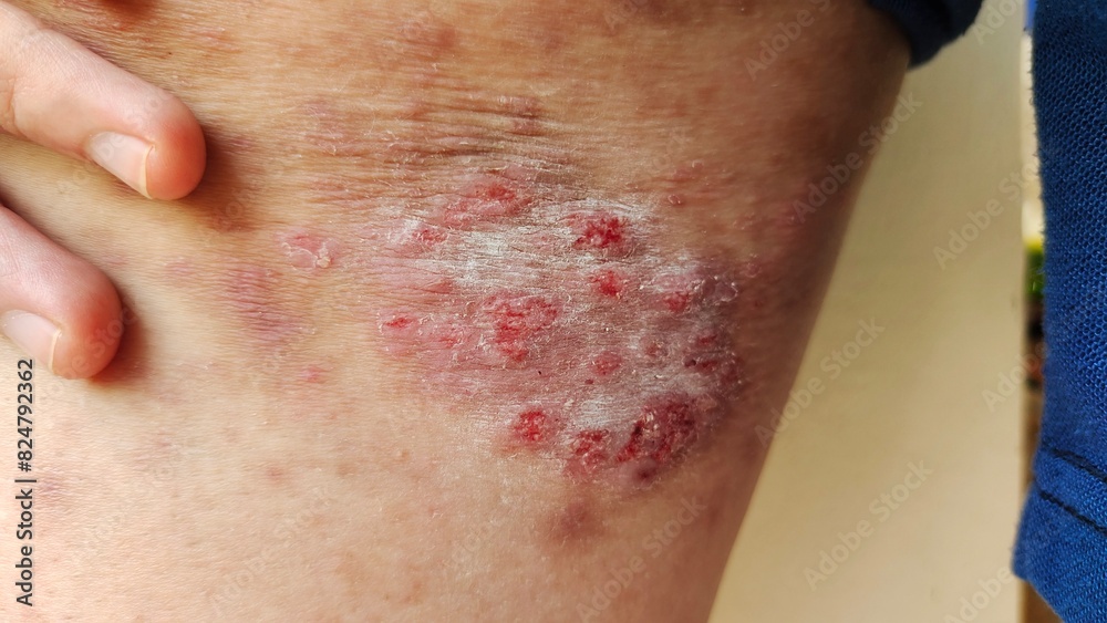 close up of a patient, holding the rash hives allergy and inflammation skin, reaction and urticaria on the leg, health care and medical concept.