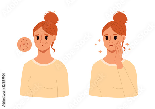 Woman with Acne Skin Problem and Compare with Healthy Skin. Skincare and Dermatology Concept. Flat Cartoon Vector Illustration.