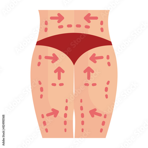 lower body lift procedure concept, remove redundant and saggy skin  from Back vector flat design, plastic surgeon Symbol  body contouring Sign Beauty treatment stock illustration