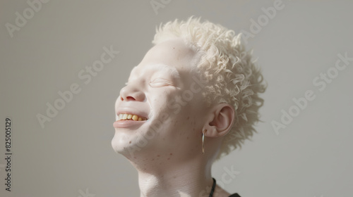 An albino man with white hair and a white face is smiling. Awareness of albinism. Albinism is a hereditary disease