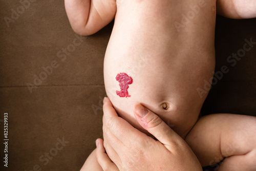 Close up of baby infantile hemangioma photo