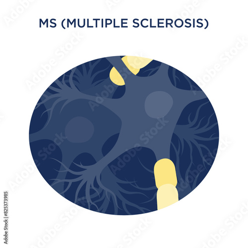 Vector icon for the autoimmune condition MS (Multiple Sclerosis)