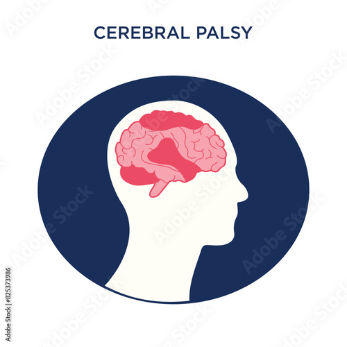Vector icon for the movement disorder Cerebral Palsy