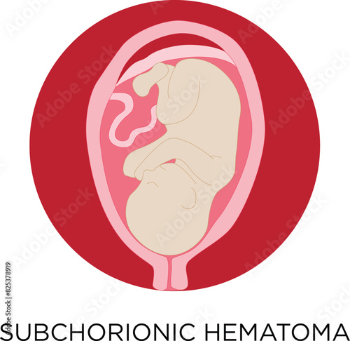 Vector medical illustration of subchorionic hematoma with blood pooling around a fetus.