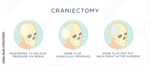 Vector illustration of craniectomy surgical procedure for traumatic brain injury.