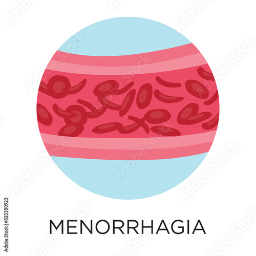 Menorrhagia (heavy blood flow) flat-style vector illustration