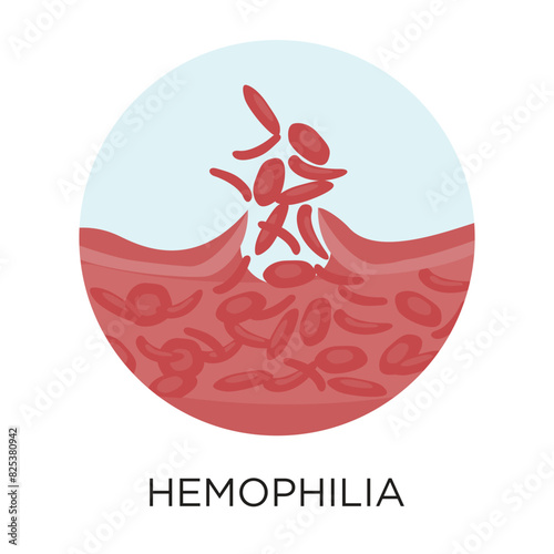 Hemophilia flat style vector illustration in circle layout with type, medical infographic