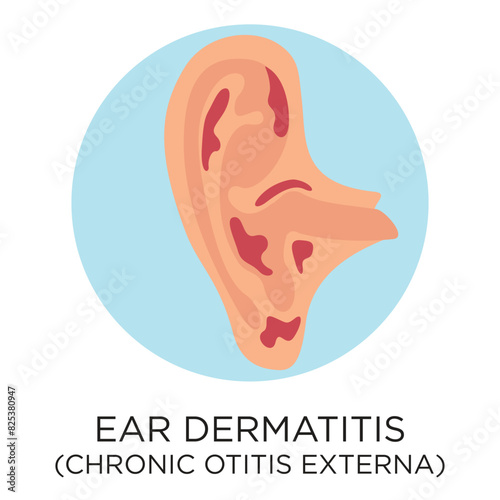 Ear dermatitis (chronic otitis externa) flat style vector illustration