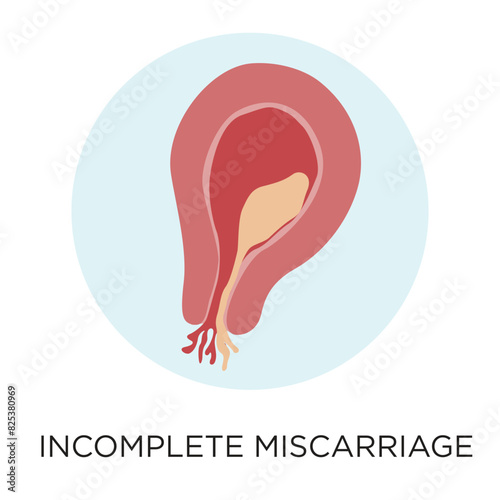 Incomplete miscarriage flat style vector illustration