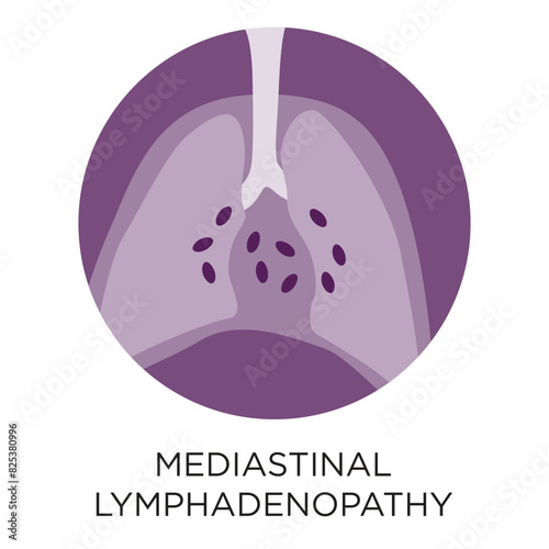 Mediastinal lymphadenopathy flat style vector illustration