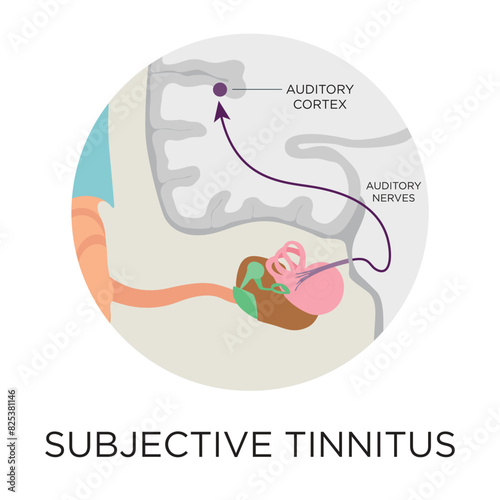 Subjective tinnitus flat style vector illustration in circle layout with type, medical infographic